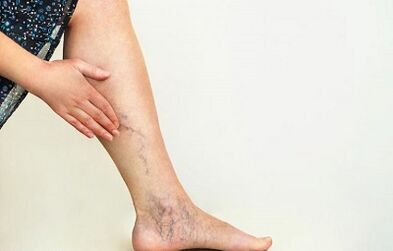 Hogyan kell kezelni az alsó végtagok varikoozusát