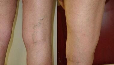 mikroflebectomia visszérre