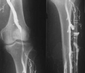 Diagnosztikai lehetőségek a végtagok varikózisára