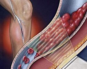 az alsó végtagok mélyvénáinak visszér